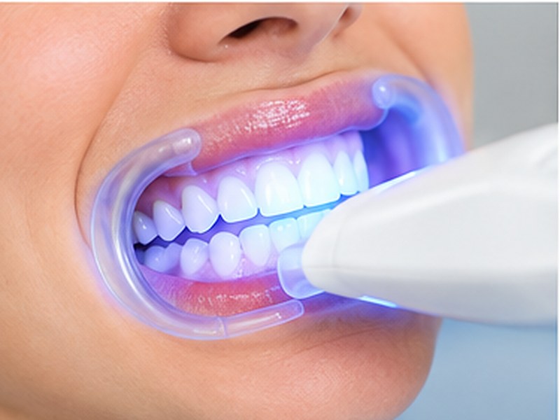 Blanqueamiento dental profesional en Valencia